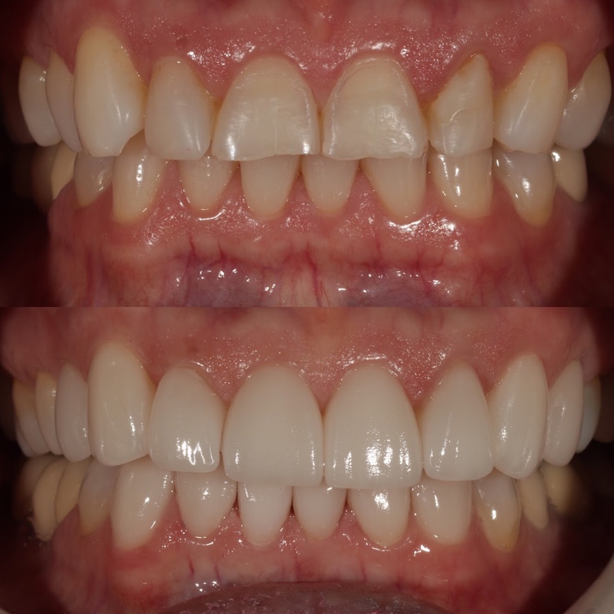 Veneers The image conveys comfort, precision, and a renewed smile, highlighting Town Dental’s cosmetic veneer expertise.